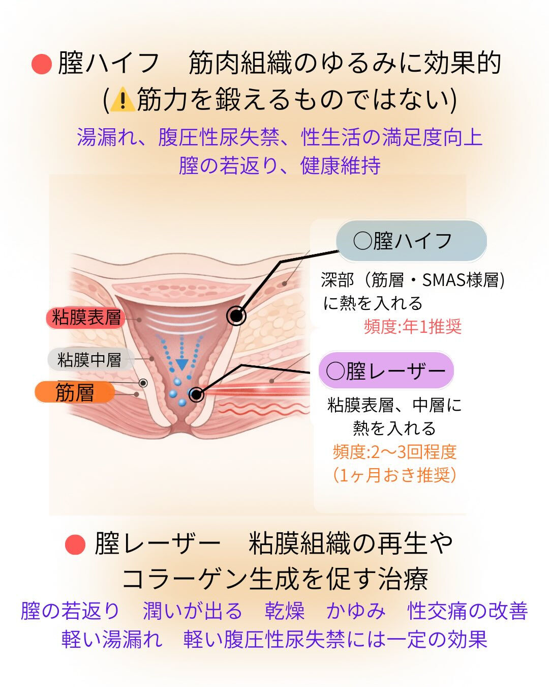 膣レーザーや膣ハイフ